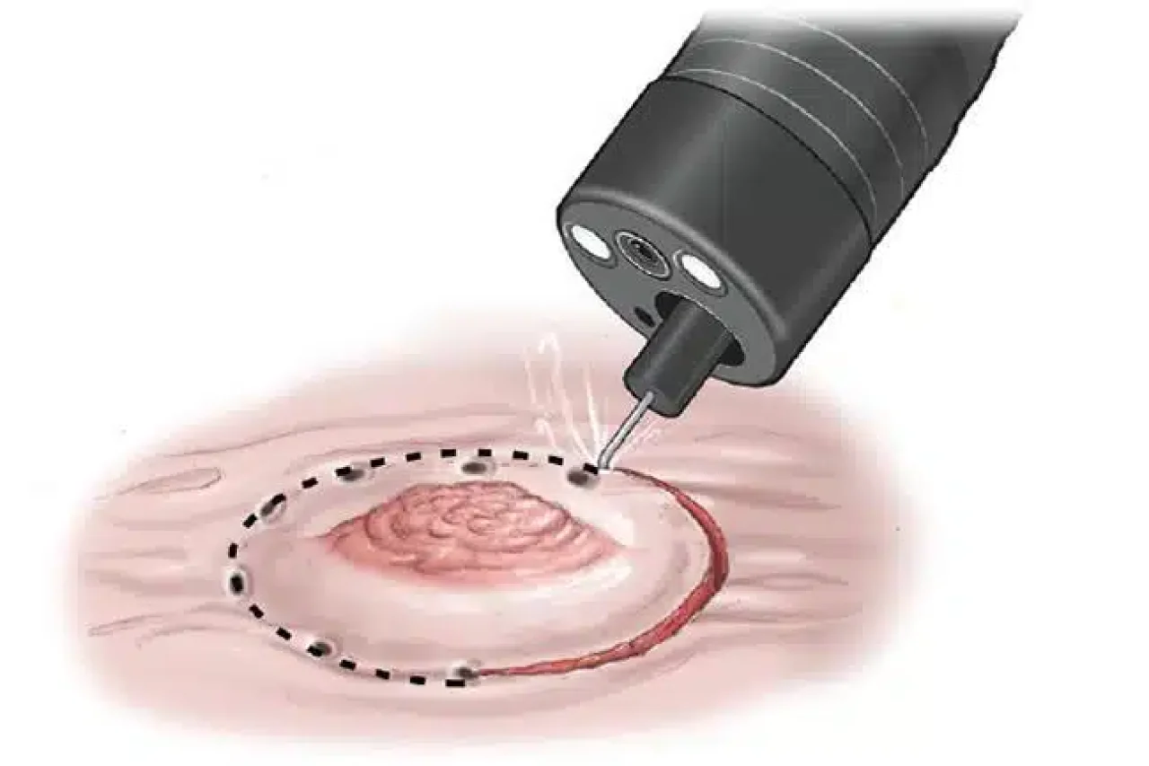 Diseccion-Endoscopica-Submucosa