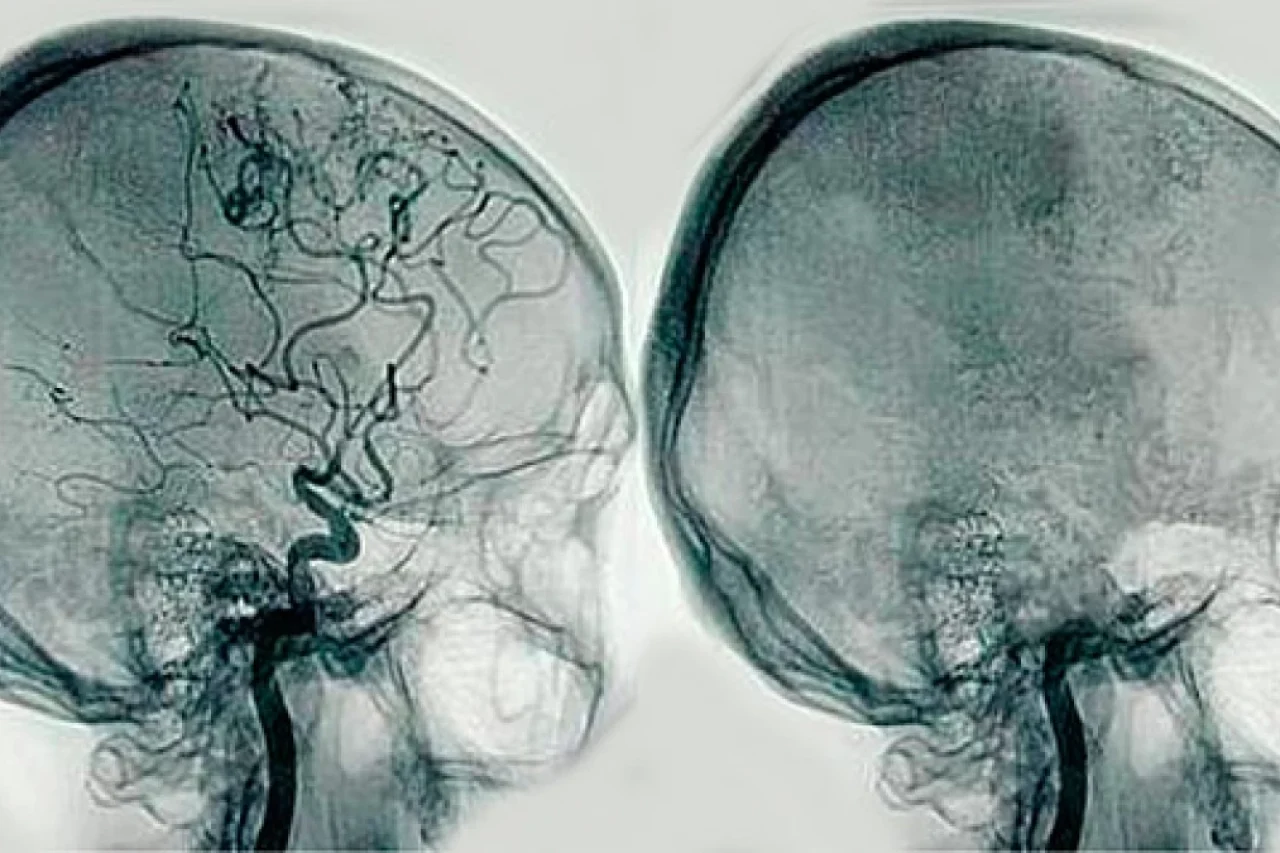 angiografia-cerebral-wide_webp